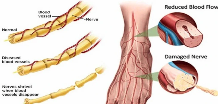 Nooro EMS Foot Massager blood circulation obstruction